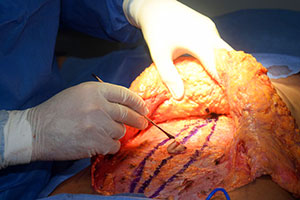 Bei Famulaturen in der plastischen / ästhetischen Chirurgie bekommt man oft auch Einblicke in die OP der Bauchdeckenstraffung (Tummy tuck).