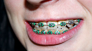 Herkömmliche Brackets helfen bei Zahnfehlstellungen, erschweren die Mundhygiene jedoch deutlich.